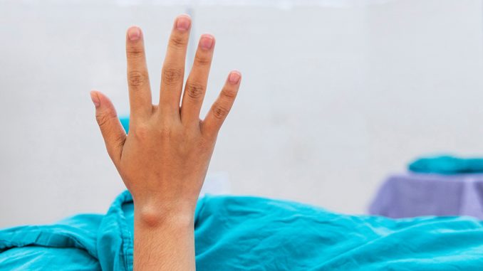 Close,Up,Photo,Of,Right,Hand,With,Carpal,Ganglion,Cyst